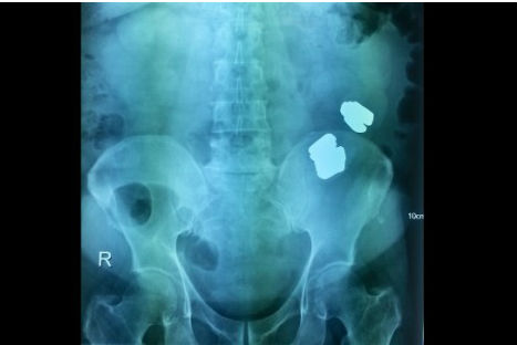 De terror: médicos encuentran oro dentro del estómago de un enfermo
