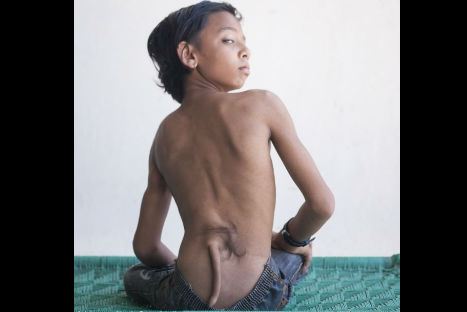 India: Niño nace con cola y es venerado India: Niño nace con cola y es venerado