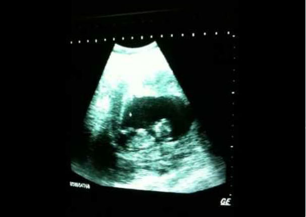 Mira cómo este bebé de tres meses de gestación juega en el vientre de su madre (VIDEO)