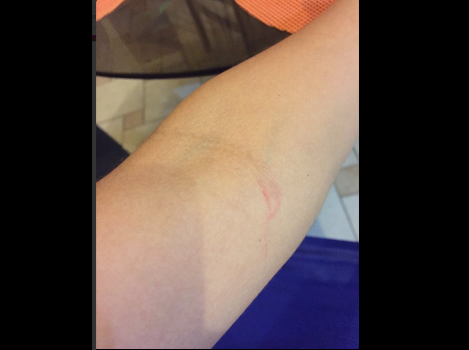 Verano Extremo: Estas son las heridas que dejó Génesis Tapia a Rosángela Espinoza - FOTOS Verano Extremo: Estas son las heridas que dejó Génesis Tapia a Rosángela Espinoza - FOTOS