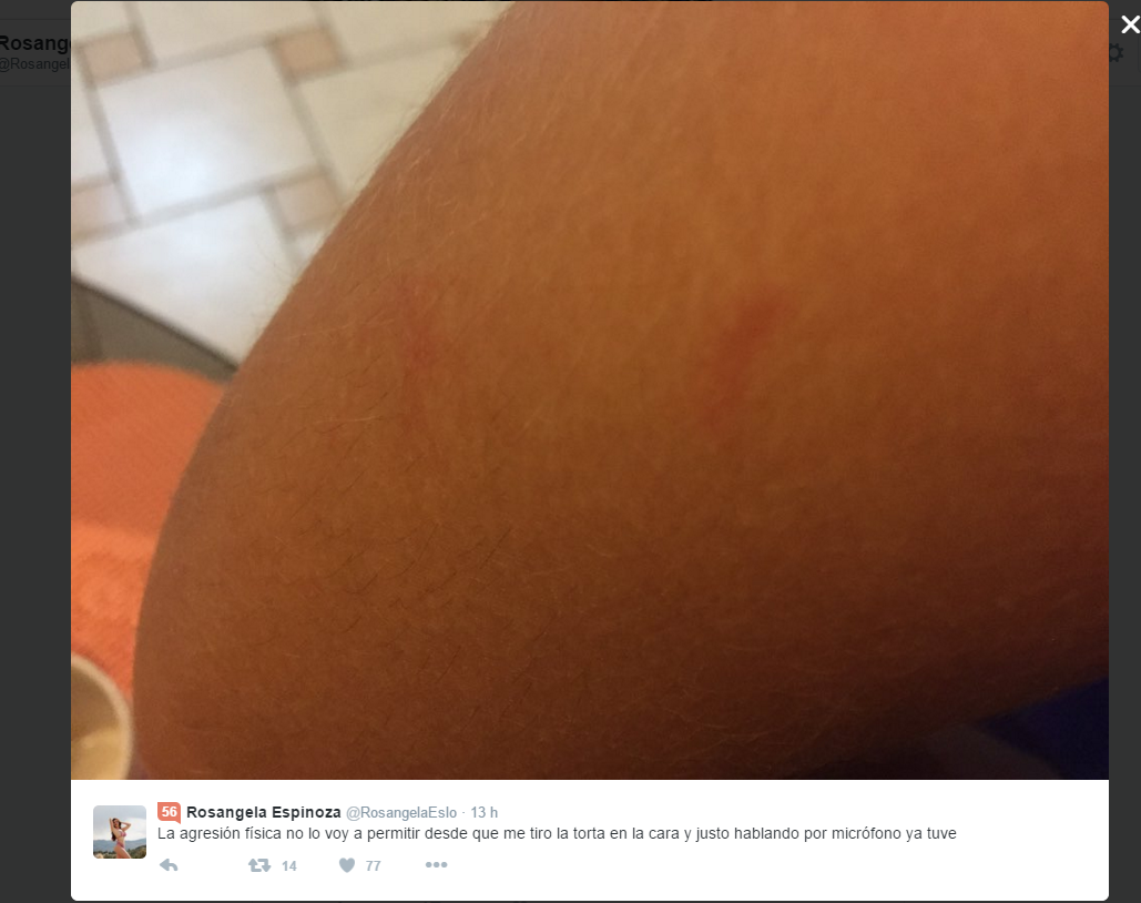 Verano Extremo: Estas son las heridas que dejó Génesis Tapia a Rosángela Espinoza - FOTOS Verano Extremo: Estas son las heridas que dejó Génesis Tapia a Rosángela Espinoza - FOTOS
