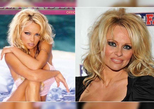 ¡Terrible! 11 famosos que abusaron del botox y las cirugías (FOTOS) ¡Terrible! 11 famosos que abusaron del botox y las cirugías (FOTOS)
