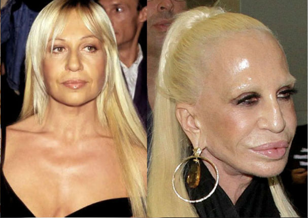 ¡Terrible! 11 famosos que abusaron del botox y las cirugías (FOTOS) ¡Terrible! 11 famosos que abusaron del botox y las cirugías (FOTOS)