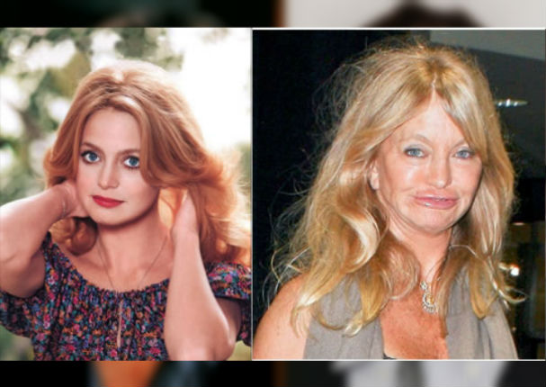 ¡Terrible! 11 famosos que abusaron del botox y las cirugías (FOTOS) ¡Terrible! 11 famosos que abusaron del botox y las cirugías (FOTOS)