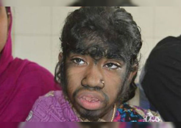 ¡Lamentable! Este es el caso de Bithi Akhtar, la 'niña lobo' de Bangladesh
