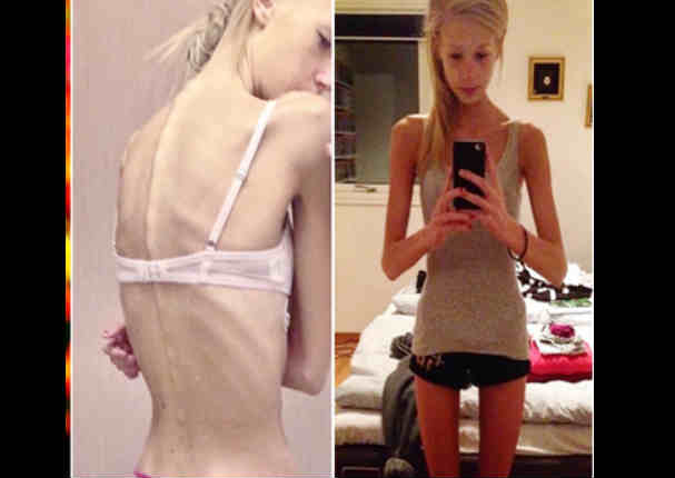 ¡Salvó su vida! Superó la anorexia y ahora luce envidiable silueta