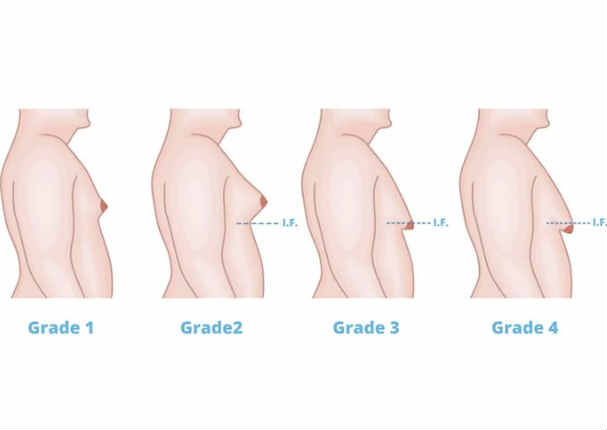 ¿Sabes por qué hay hombres con pechos grandes? Esta es la razón