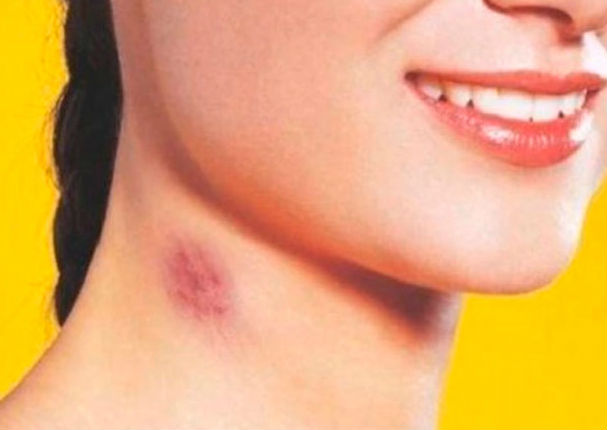 3 tips para eliminar los 'chupetones' del cuello