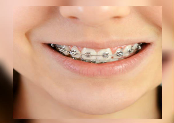 Facebook Viral: Joven de 15 años casi muere al usar brackets (VIDEO)