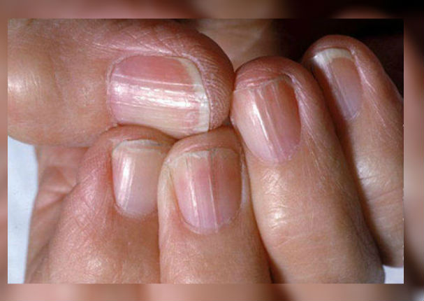 Tus uñas podrían decir mucho sobre tu estado de salud Tus uñas podrían decir mucho sobre tu estado de salud